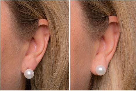Levears launches the earring lifts